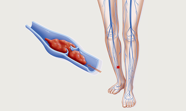 Deep vein thrombosis