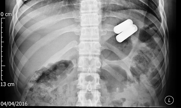 Foreign body ingestion