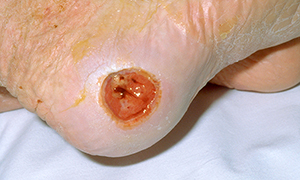Pressure injuries