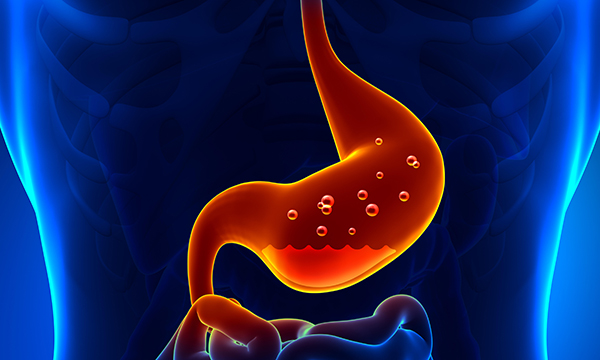 Acid reflux