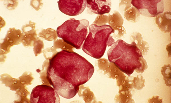 Acute_myeloid_leukaemia