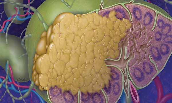 Continuing professional development: lymphoma in primary care