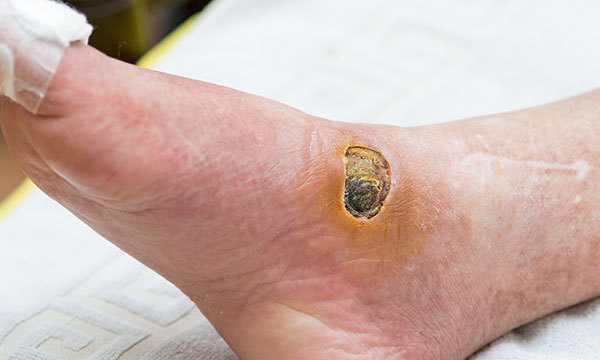 Undertaking a person-centred assessment of patients with chronic wounds