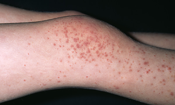 Early recognition and treatment of Henoch-Schönlein purpura in children