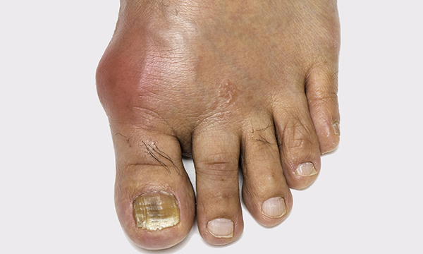 Picture shows a foot affected by gout. Most patients treated by nurses for gout were more satisfied, had greater knowledge, stuck to their medication and had fewer flares than those treated by a GP. 