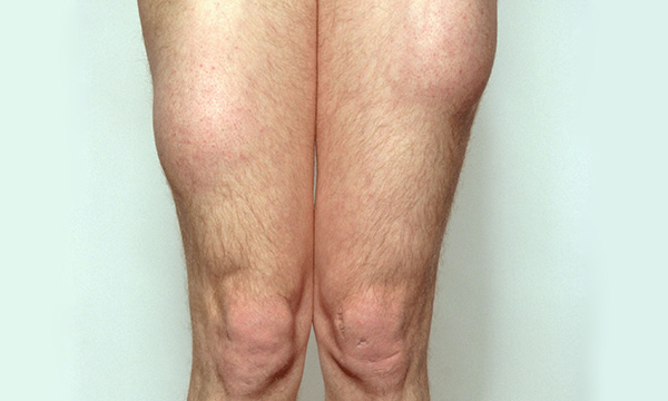 Frequency of injection site assessment for lipohypertrophy in children and young people with type 1 diabetes