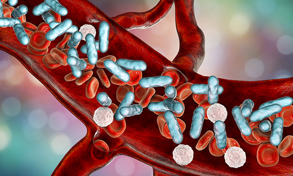 Illustration of sepsis