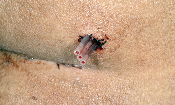 Effective drain care and management in community settings