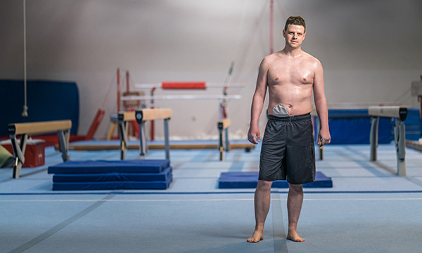 Assessing physical activity levels in people living with a stoma