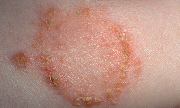 How to manage PVL-associated Staphylococcus aureus infections in primary care