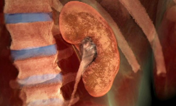 Illustration of a diseased kidney