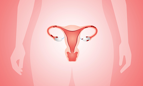 Image of a uterus with endometriosis