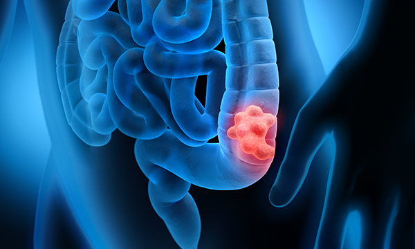 An illustration representing colorectal cancer. New guidance covers the management of local disease and secondary tumours.