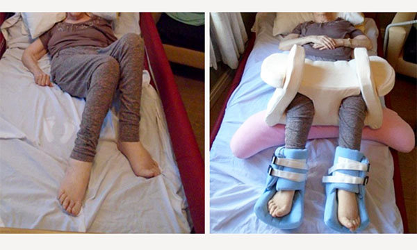 Use of night-time positioning equipment in care home residents with postural asymmetry: a pilot study