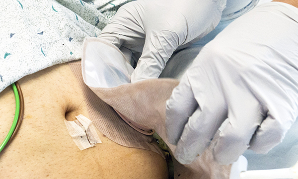 How to change a stoma bag