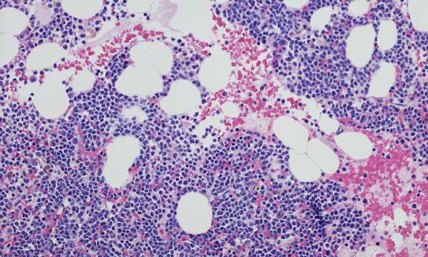 Evaluating a digital self-management tool for people living with multiple myeloma