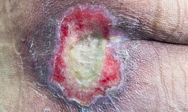 Using the ‘aSSKINg’ model in pressure ulcer prevention and care planning