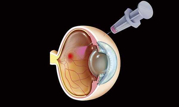 An overview of diabetic retinopathy and other ocular complications of diabetes mellitus