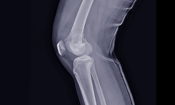 Bone tumour
