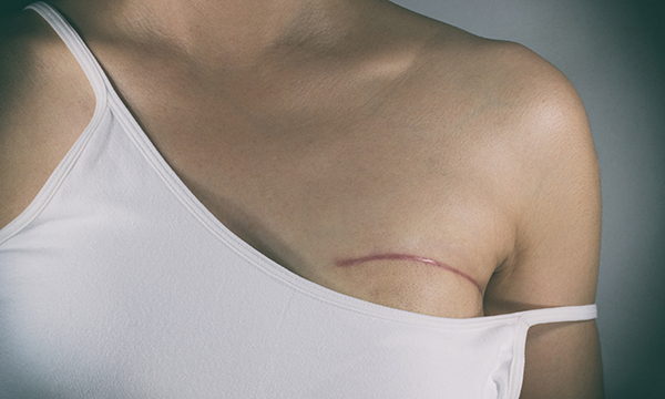 Women’s perceptions of body image post-mastectomy: a literature review