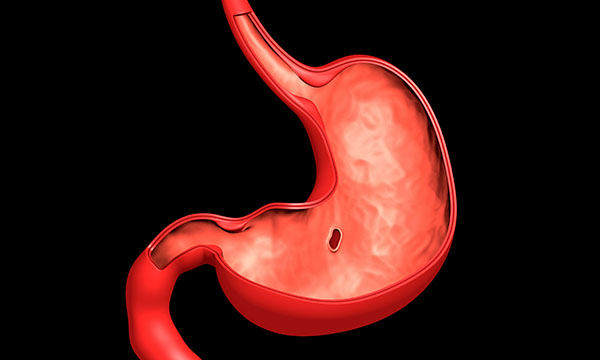 Managing a patient presenting to the emergency department with upper gastrointestinal bleeding