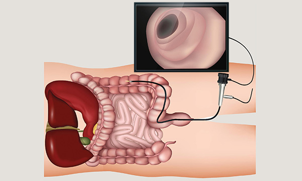 Colonoscopy: an evidence-based approach