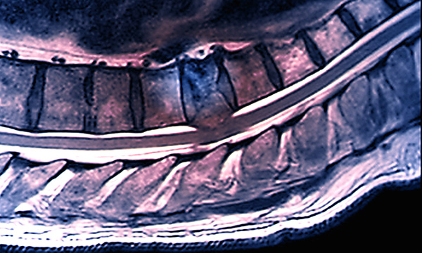 Metastatic spinal cord compression: a poster and mnemonic supporting acute hospital staff to deliver optimal patient care