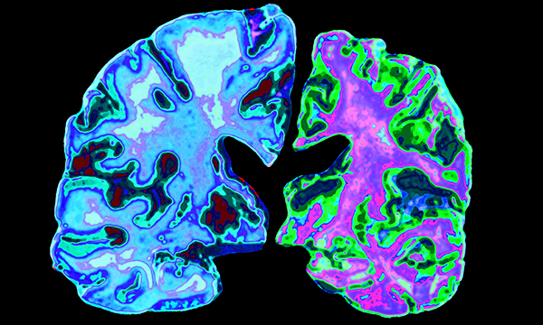 Exploring nursing students’ knowledge of Alzheimer’s disease