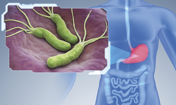 Helicobacter pylori testing and treatment: experience and reflections of a community learning disability team