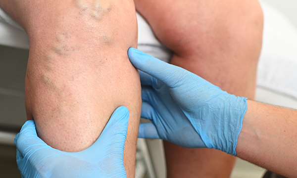 Understanding patient assessment and treatment in deep vein thrombosis