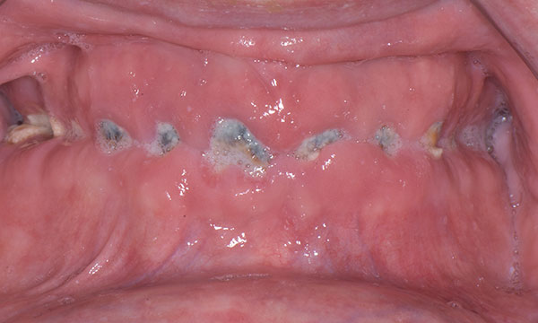 Rapid dental deterioration after radiotherapy for oral cancer: a case report