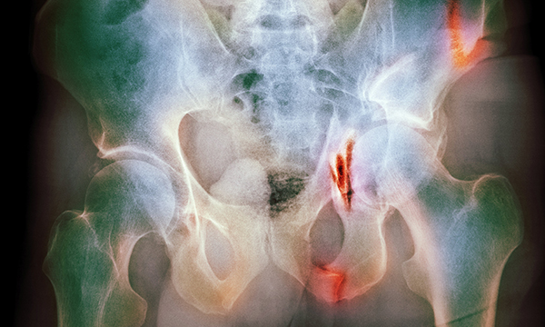 Assessment and management of pelvic fractures from high-energy trauma in adults