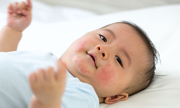 Atopic eczema and the barriers to treatment adherence for children: a literature review 