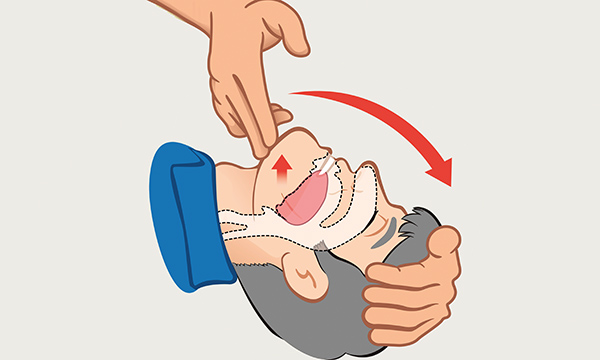 Recognising suspected stroke in patients and providing optimal immediate care