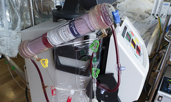 Acute kidney injury in the critical care setting