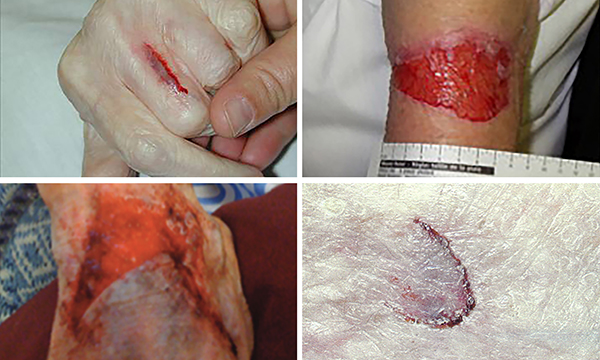 Preventing and recognising skin tears using a standardised approach