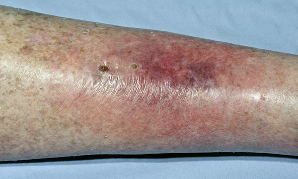 Diagnosing, assessing and managing cellulitis 