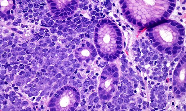 Investigating overall quality of life in patients with diffuse large B-cell lymphoma undergoing CAR T-cell therapy