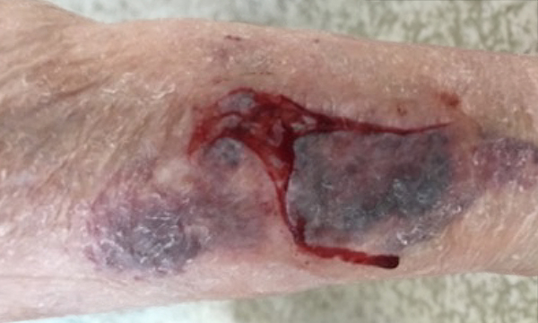 Assessment, prevention and management of skin tears in older people