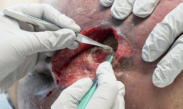 Undertaking a structured assessment of a hard-to-heal wound