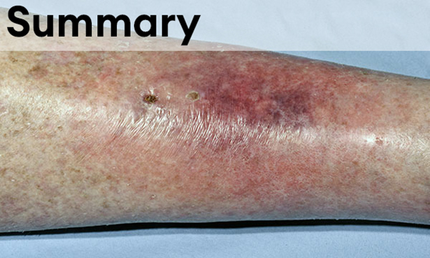 Cellulitis is an acute bacterial infection of the deep dermis and surrounding subcutaneous tissue. Image shows a limb affected by cellulitis