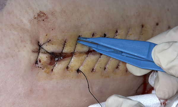 How to remove non-absorbable sutures 