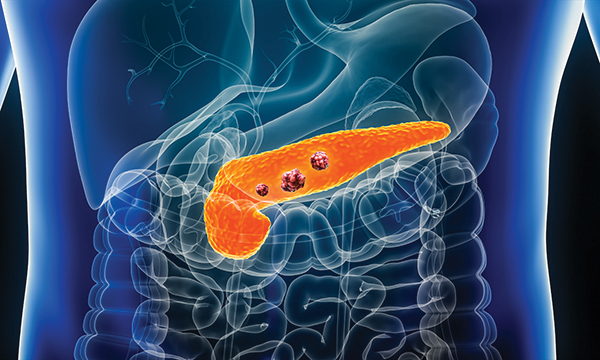 Advances in the early detection of pancreatic cancer – a literature review