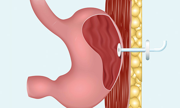 How to administer a percutaneous endoscopic gastrostomy (PEG) feed