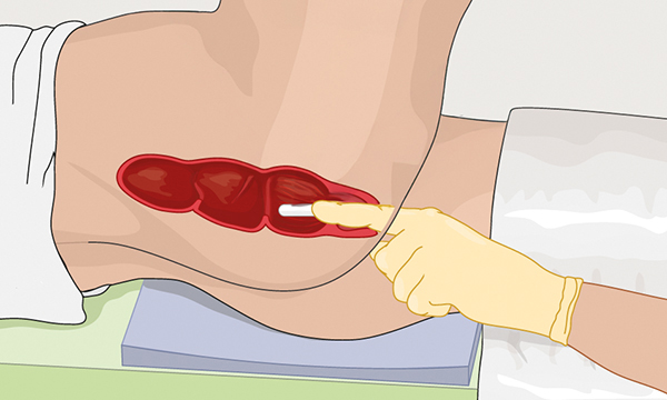 How to administer suppositories in adults with constipation