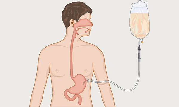 Exploring the differences between percutaneous endoscopic gastrostomy and radiologically inserted gastrostomy tubes