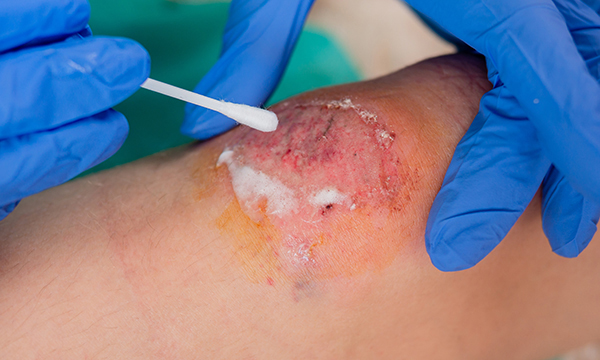 How to take a wound swab
