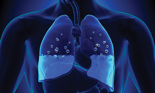 Illustration showing potentially-life threatening pulmonary oedema as a result of fluid overload 