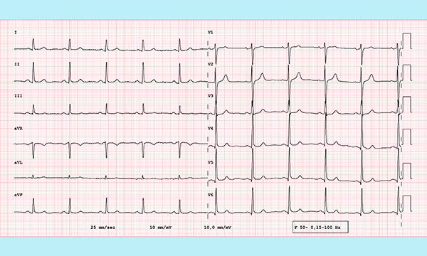 How to accurately record a 12-lead ECG
