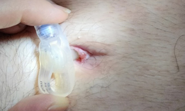 Overgranulation of stoma sites in children with an enteral feeding tube: an evidence-based treatment pathway